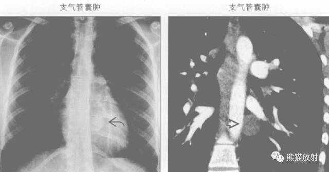 “纵隔囊性肿块”的鉴别诊断