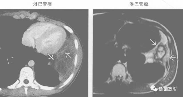 “纵隔囊性肿块”的鉴别诊断