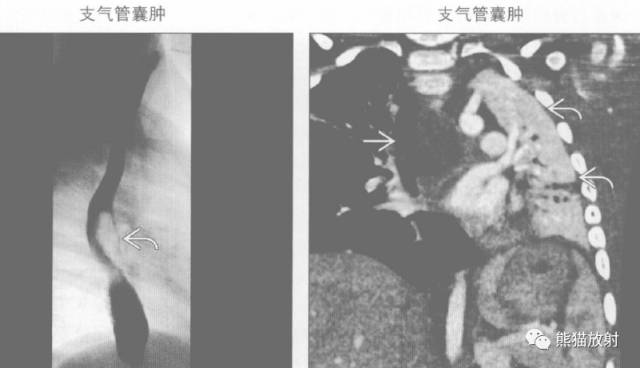 “纵隔囊性肿块”的鉴别诊断