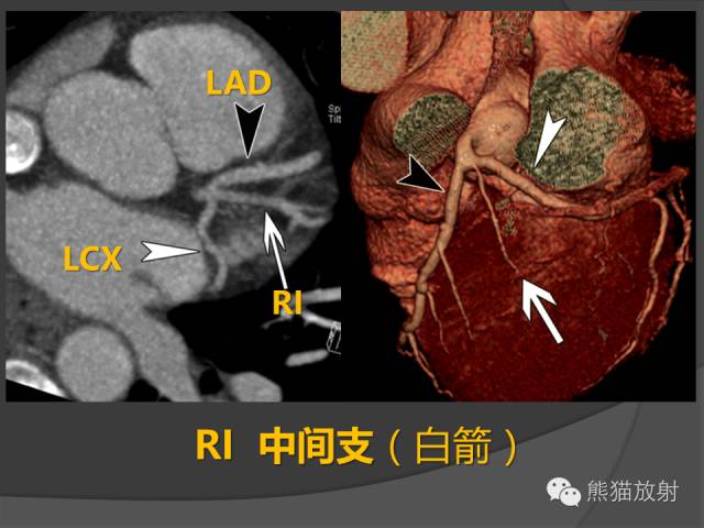 【PPT】冠状动脉解剖