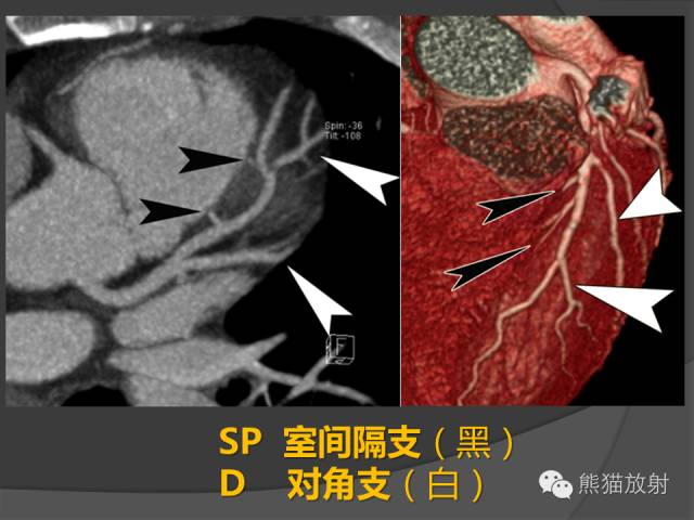 【PPT】冠状动脉解剖