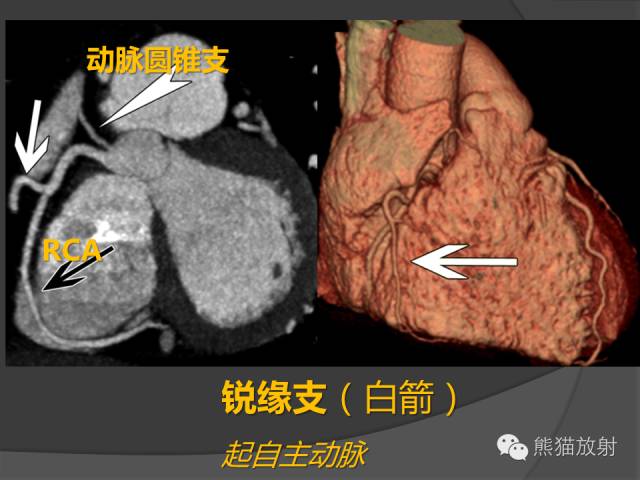 【PPT】冠状动脉解剖