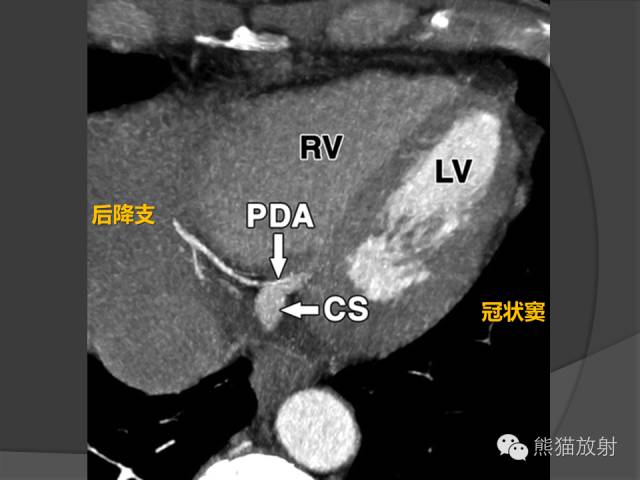 【PPT】冠状动脉解剖