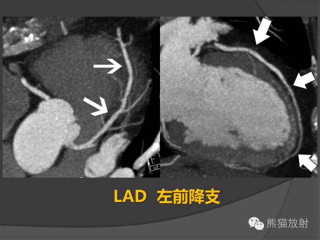 【PPT】冠状动脉解剖
