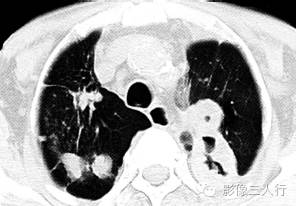 【病例】继发性肺结核1例CT影像表现分析