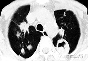 【病例】继发性肺结核1例CT影像表现分析