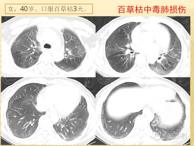 【PPT】间质性肺疾病的鉴别诊断