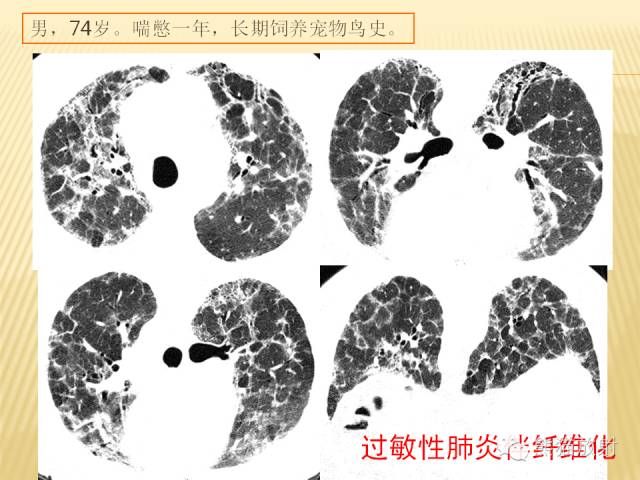 【PPT】间质性肺疾病的鉴别诊断