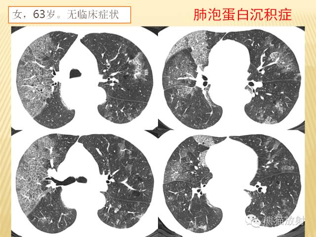 【PPT】间质性肺疾病的鉴别诊断