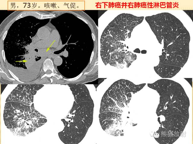 【PPT】间质性肺疾病的鉴别诊断