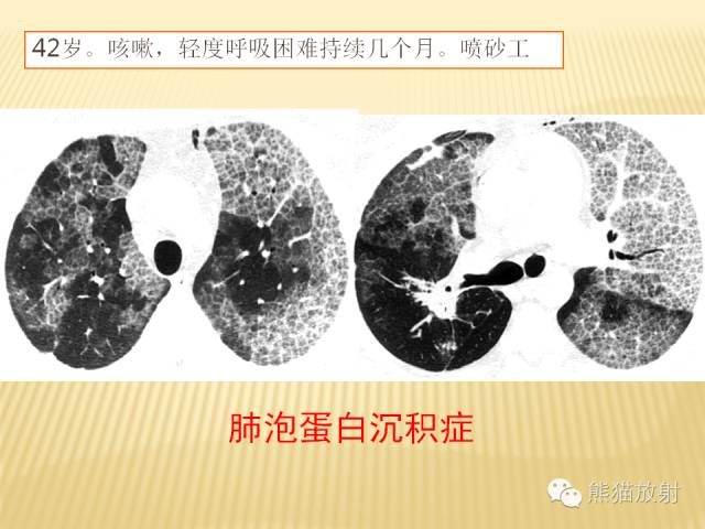 【PPT】间质性肺疾病的鉴别诊断