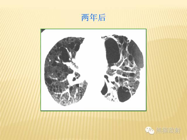 【PPT】间质性肺疾病的鉴别诊断