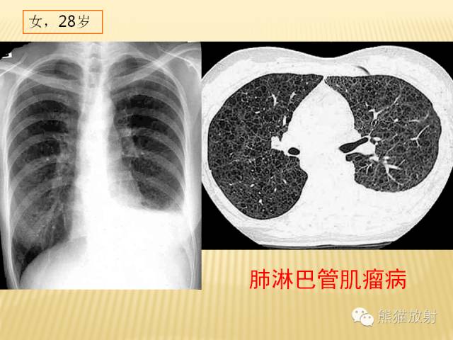 【PPT】间质性肺疾病的鉴别诊断