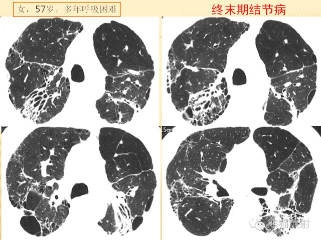【PPT】间质性肺疾病的鉴别诊断