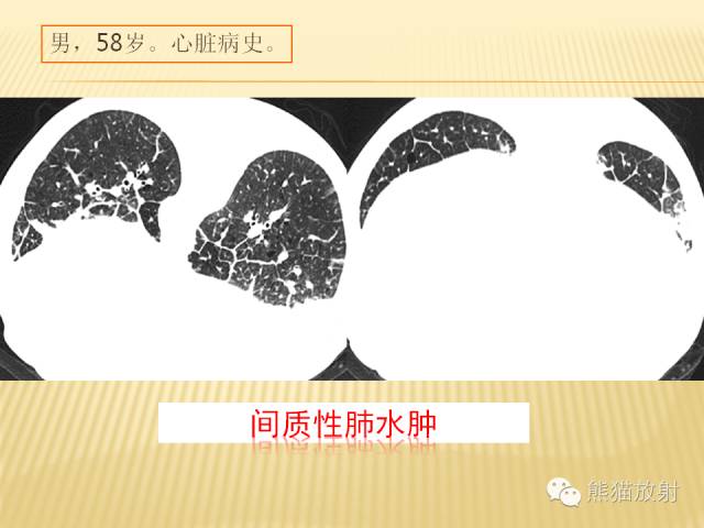 【PPT】间质性肺疾病的鉴别诊断
