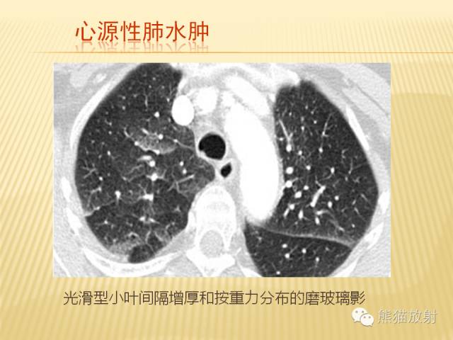 【PPT】间质性肺疾病的鉴别诊断