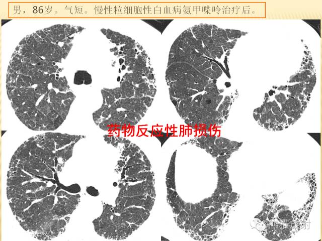 【PPT】间质性肺疾病的鉴别诊断