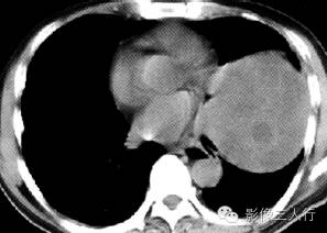 【病例】肺癌肉瘤1例X线CT影像表现 【病例】肺癌肉瘤1例X线CT影像表现