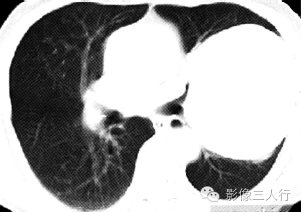 【病例】肺癌肉瘤1例X线CT影像表现 【病例】肺癌肉瘤1例X线CT影像表现