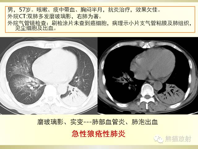 【PPT】风湿免疫病肺部病变CT表现