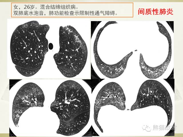 【PPT】风湿免疫病肺部病变CT表现