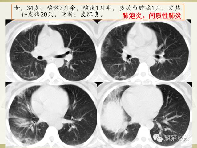 【PPT】风湿免疫病肺部病变CT表现