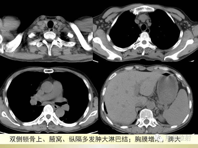 【PPT】风湿免疫病肺部病变CT表现