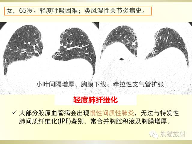 【PPT】风湿免疫病肺部病变CT表现