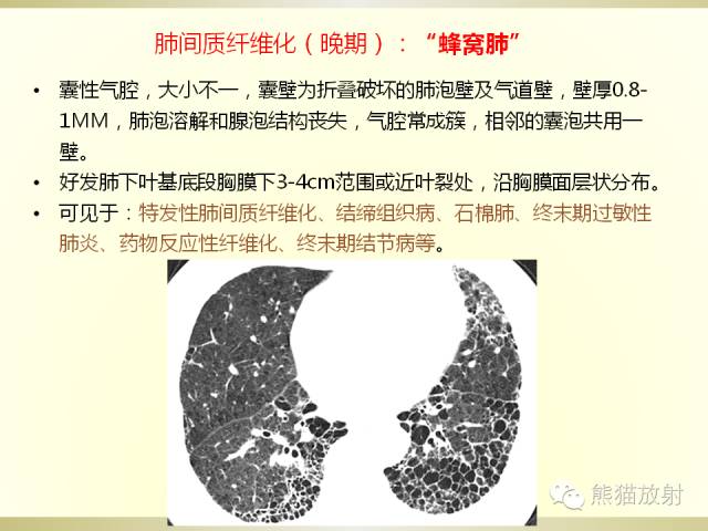 【PPT】风湿免疫病肺部病变CT表现