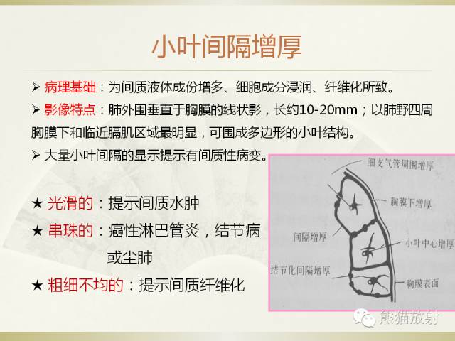 【PPT】风湿免疫病肺部病变CT表现