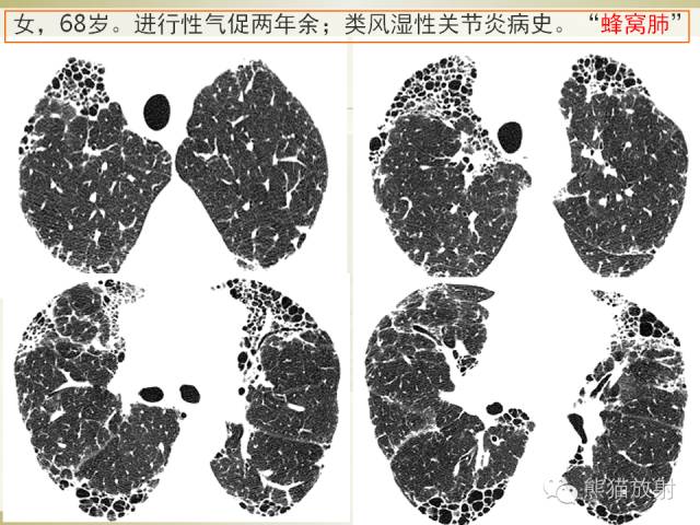 【PPT】风湿免疫病肺部病变CT表现