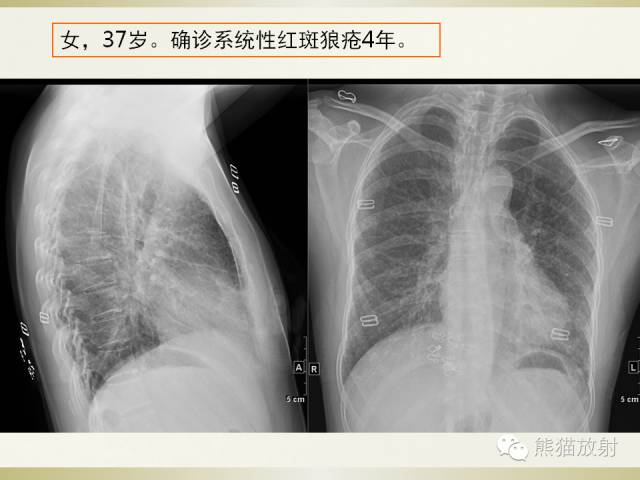 【PPT】风湿免疫病肺部病变CT表现