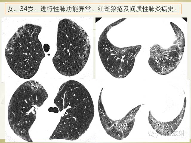 【PPT】风湿免疫病肺部病变CT表现