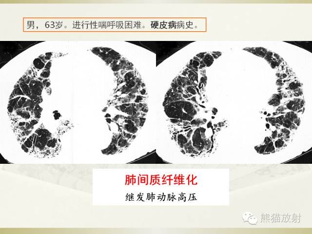 【PPT】风湿免疫病肺部病变CT表现