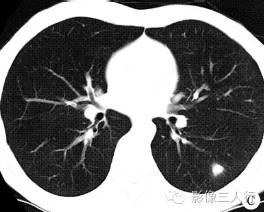 【病例】侵袭性肺曲菌病1例CT影像表现 【病例】侵袭性肺曲菌病1例CT影像表现