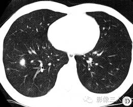 【病例】侵袭性肺曲菌病1例CT影像表现 【病例】侵袭性肺曲菌病1例CT影像表现
