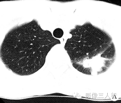 【病例】侵袭性肺曲菌病1例CT影像表现
