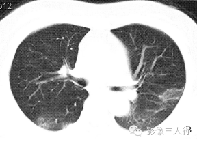 【病例】慢性嗜酸性细胞肺浸润1例CT影像表现分析 【病例】慢性嗜酸性细胞肺浸润1例CT影像表现分析
