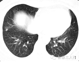 【病例】慢性嗜酸性细胞肺浸润1例CT影像表现分析