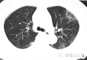 【病例】慢性嗜酸性细胞肺浸润1例CT影像表现分析