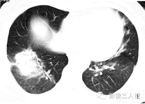 【病例】慢性嗜酸性细胞肺浸润1例CT影像表现分析 【病例】慢性嗜酸性细胞肺浸润1例CT影像表现分析