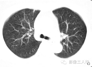 【病例】慢性嗜酸性细胞肺浸润1例CT影像表现分析