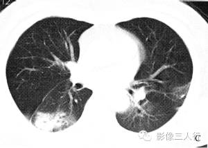 【病例】慢性嗜酸性细胞肺浸润1例CT影像表现分析 【病例】慢性嗜酸性细胞肺浸润1例CT影像表现分析