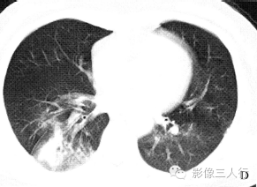 【病例】慢性嗜酸性细胞肺浸润1例CT影像表现分析 【病例】慢性嗜酸性细胞肺浸润1例CT影像表现分析
