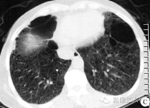 【病例】肺淋巴管平滑肌瘤病1例CT影像表现 【病例】肺淋巴管平滑肌瘤病1例CT影像表现