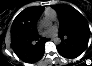 【病例】肺淋巴管平滑肌瘤病1例CT影像表现 【病例】肺淋巴管平滑肌瘤病1例CT影像表现