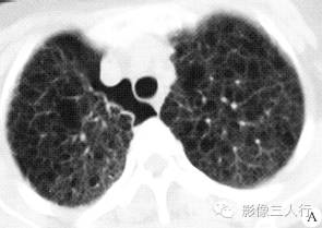 【病例】肺淋巴管平滑肌瘤病1例CT影像表现
