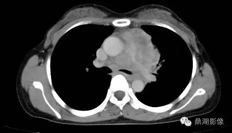 【PPT】纵隔淋巴瘤1例CT影像表现