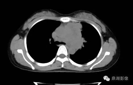【PPT】纵隔淋巴瘤1例CT影像表现
