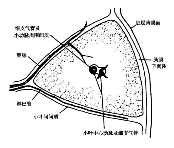 肺淋巴管肌瘤病的CT诊断及常见鉴别诊断